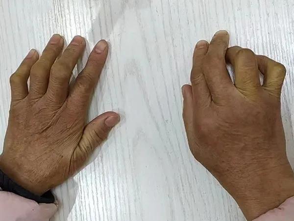 类风湿严重会有什么后果,类风湿严重了会得强直性脊柱炎吗