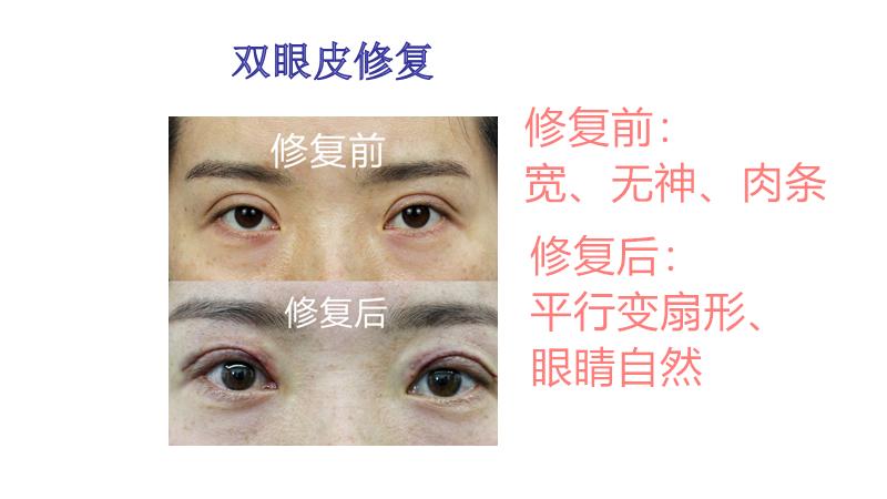 平行双眼皮和开扇形哪个更好看,平行双眼皮变成扇形双眼皮