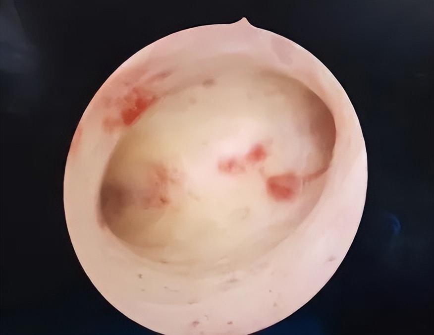 妇科宫腔镜科普宣教,关爱子宫神奇的宫腔镜