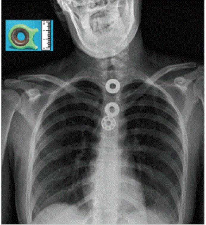 不小心吞进了乐高怎么办,不小心把乐高吞进肚子有事吗