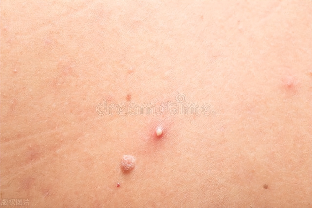 皮肤长小肉球是什么症状,皮肤长小疙瘩小肉球怎么弄