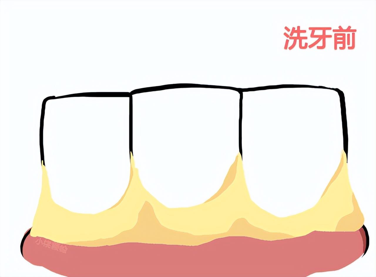 洗牙牙缝变大的原因和解决方法,牙缝特别小怎么洗牙