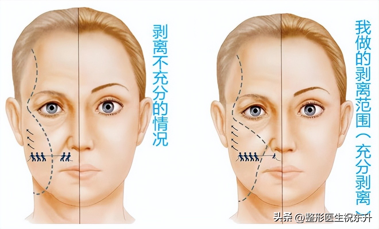 自己在家做拉皮为什么做不好,在家做拉皮的方法全过程