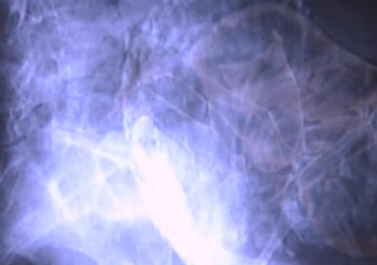 2007年四川90岁老妇，腹中怀子60年未生，后检查发现胎儿没有腐烂