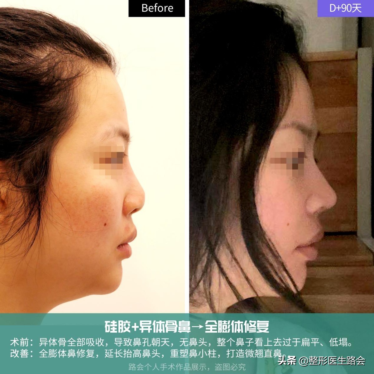 隆鼻失败鼻头有个坑的原因,隆鼻失败导致的鼻头凹陷怎么修复