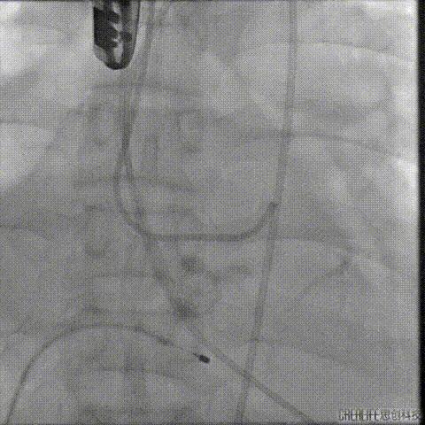 病例回顾与分享,腹膜后血肿介入治疗