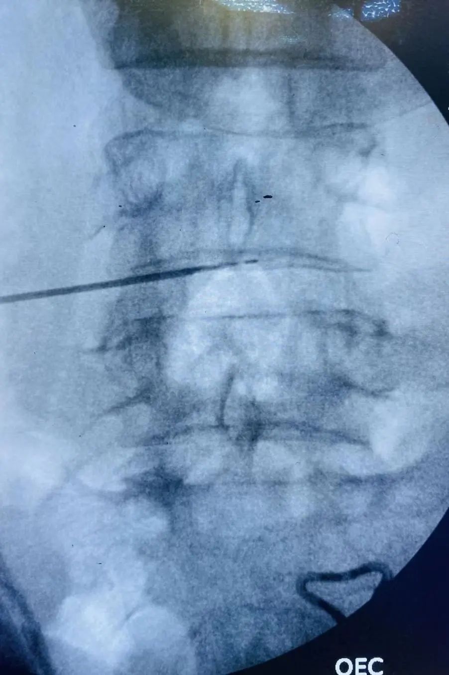 等离子脊柱微创手术,脊柱微创射频消融术