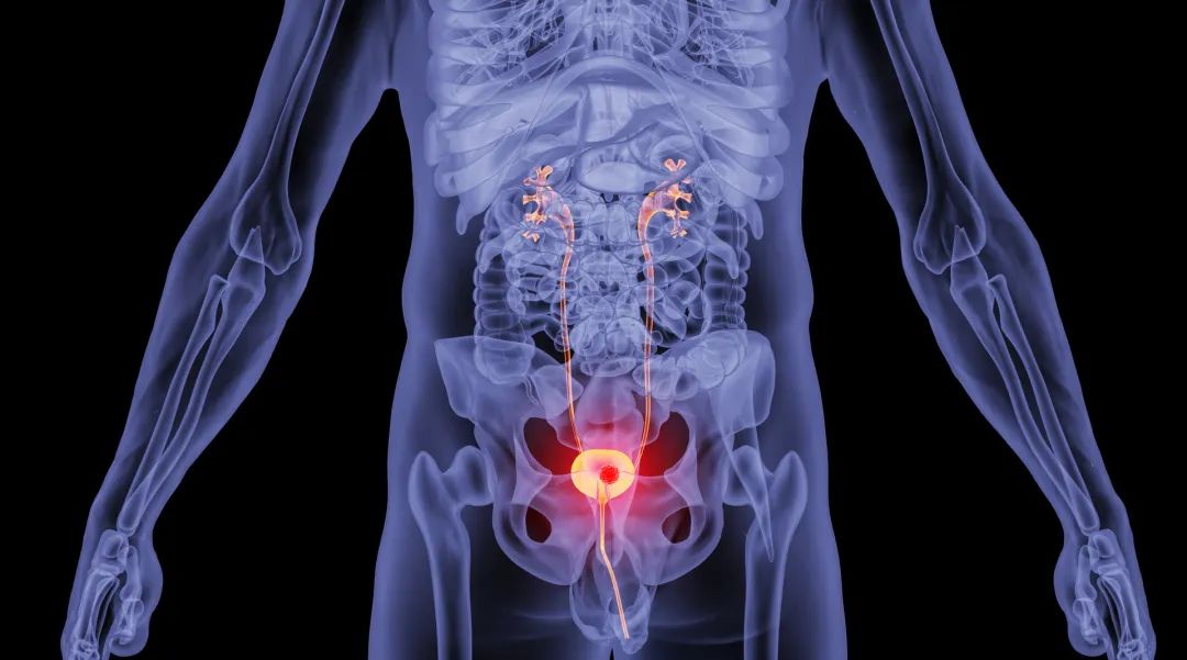 肾结石出现血尿,肾炎会出现血尿吗