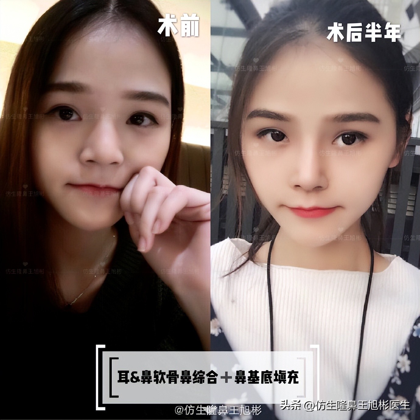 肋软骨的缺点与好处,科普什么是肋软骨鼻综合