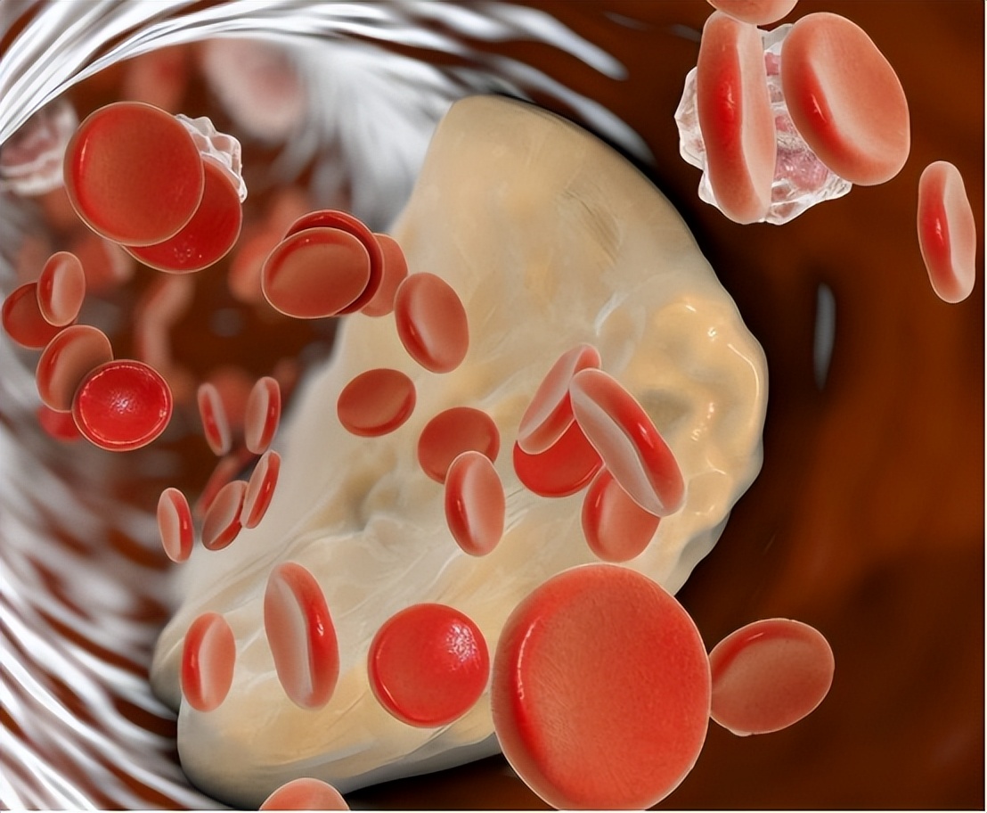 低密度脂蛋白高的2个解决办法,低密度脂蛋白偏高怎么才能降下来