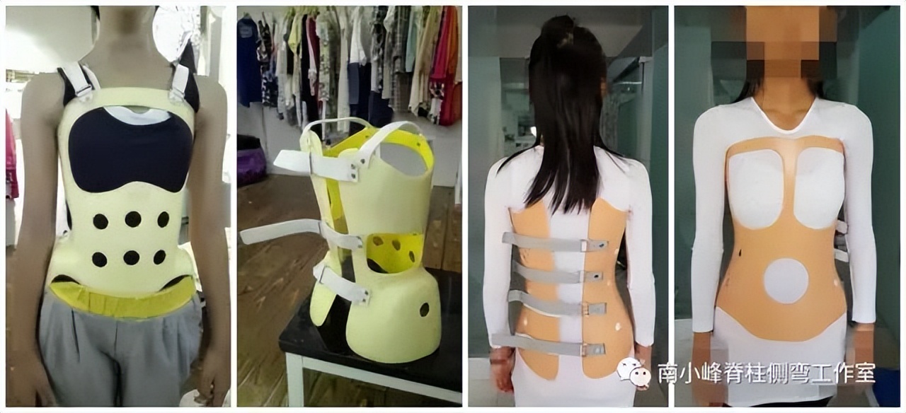 脊柱侧弯矫正支具不调整会怎样,简单辨别脊柱侧弯避免孩子走弯路