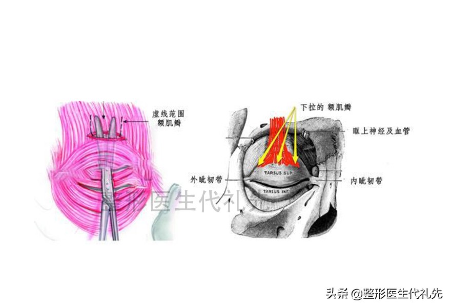整形医生俞海燕眼睑外翻,眼睑外翻怎么修复