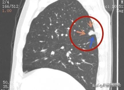 肺腺癌高危亚型什么意思,肺腺癌高危亚型