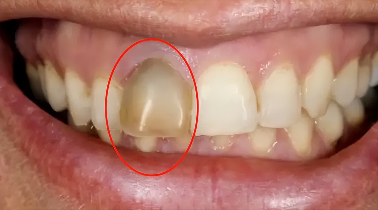 怎样知道牙髓有没有坏死,怎样判断牙髓坏死了