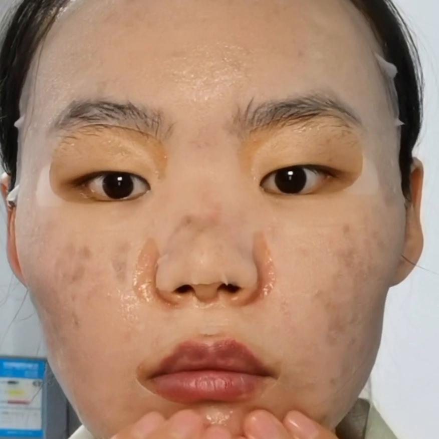 点阵激光后日常护理,点阵激光术后喷雾推荐