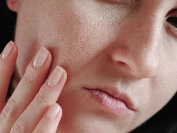 毛孔粗大脸颊两侧毛孔大,脸颊毛孔粗大毛孔发红