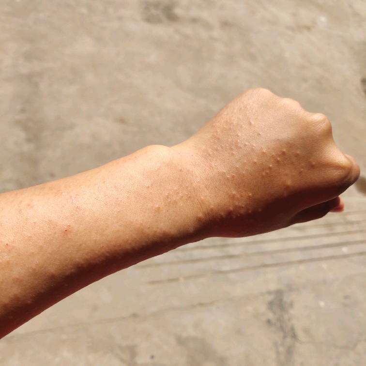 吃了中药湿疹冒得更多是什么原因,湿疹反反复复用什么中药治疗最好