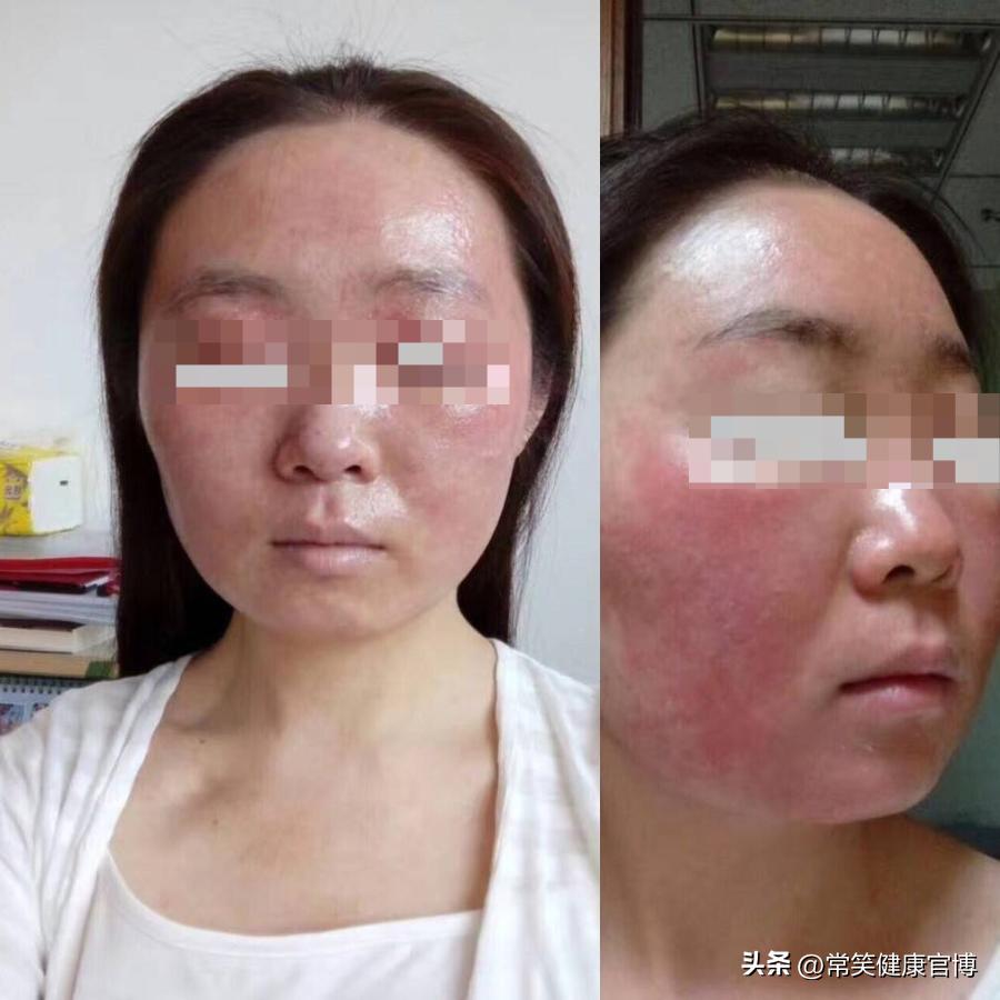 激素依赖性皮炎怎么才可以治愈,激素依赖性皮炎高发期如何缓解