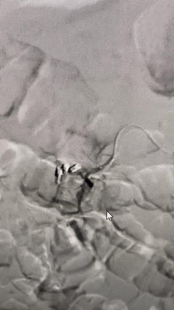 上消化道出血病人抢救,消化道出血病人的护理个案