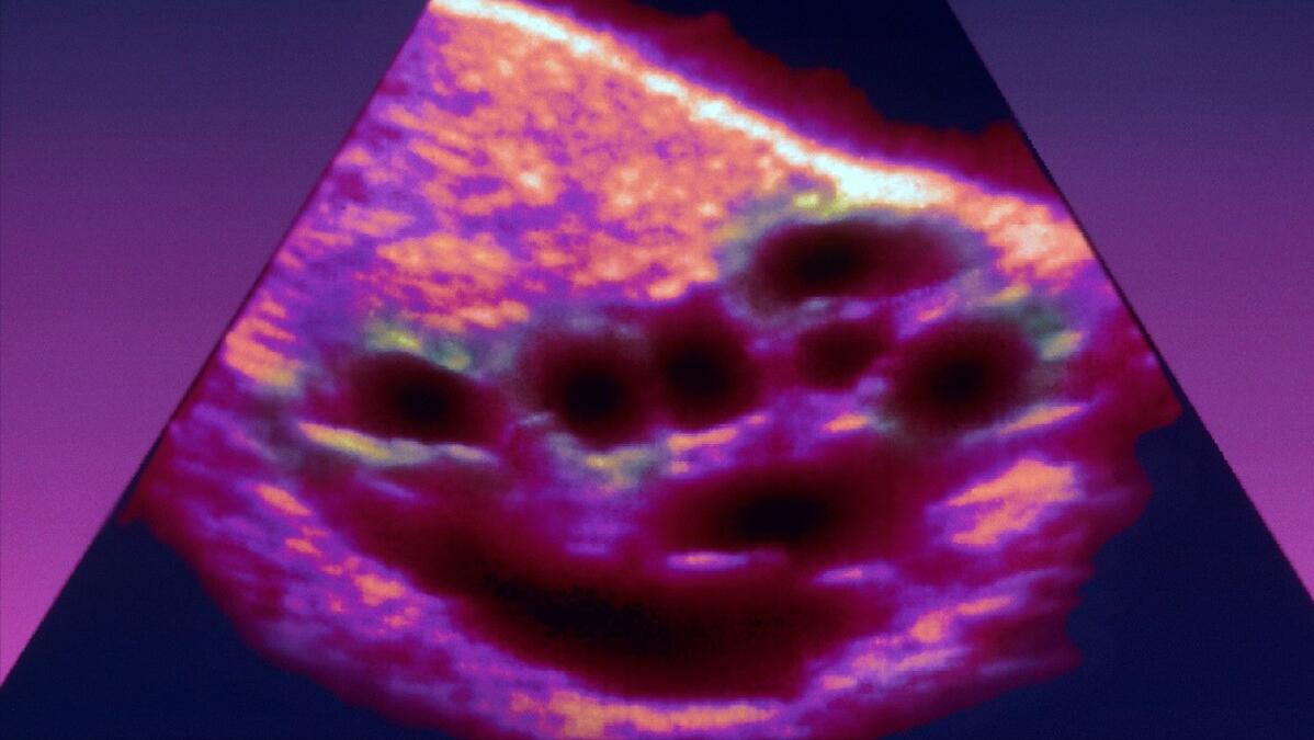 治疗多囊卵巢的中药方视频,多囊卵巢中医食疗验方