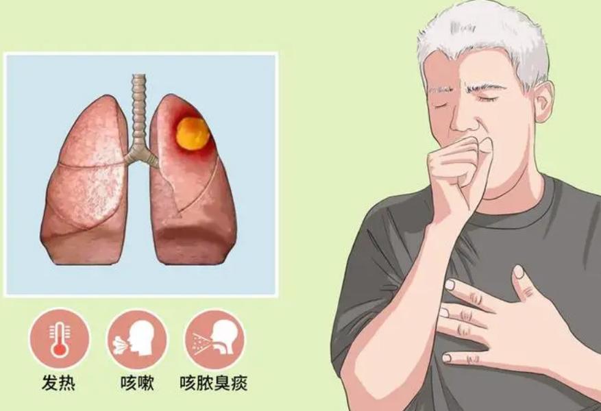 畏寒发热咳浓痰治疗方法,畏寒黄痰咳嗽