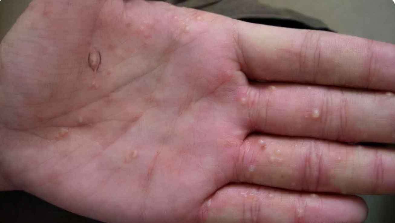 手上起水泡是脚气传染还是汗疱疹,手上起小水泡汗疱疹用什么药