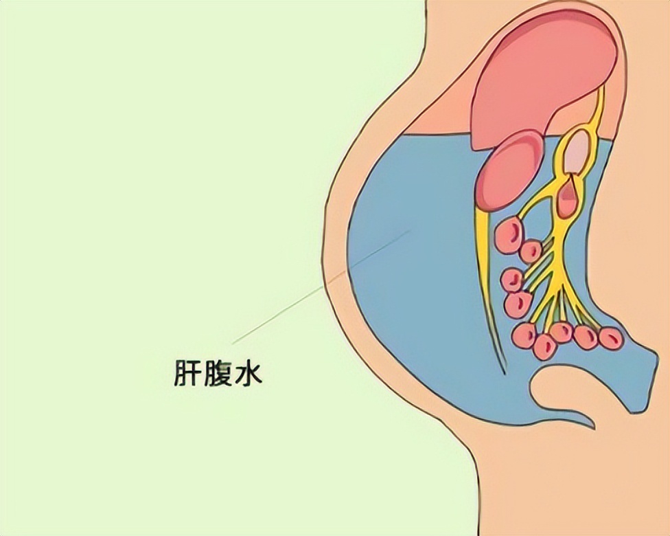肝硬化腹水湖南中医治疗,刘教授治疗肝腹水