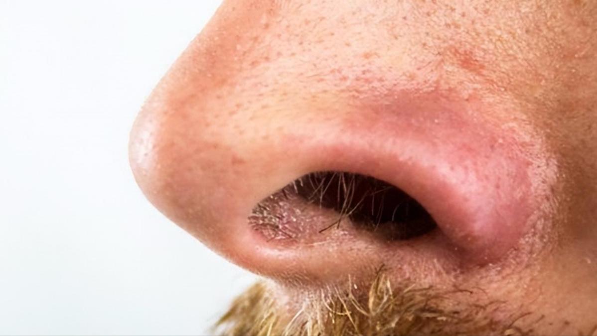 鼻毛白是变老了吗,鼻毛变白是什么原因怎么治疗