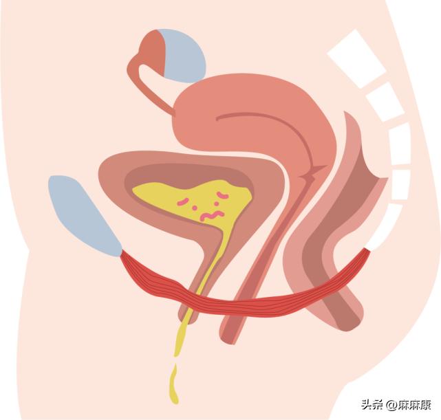 盆腔脏器脱垂的治疗方法有哪几种,子宫切除后如何预防盆腔脏器脱垂