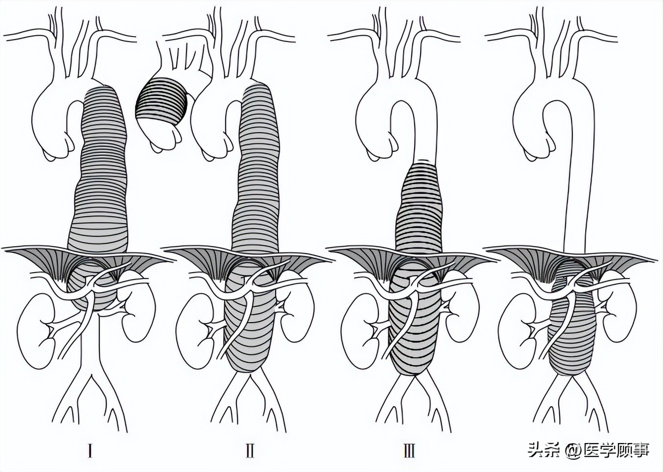 主动脉瘤和主动脉夹层科普视频,主动脉夹层动脉瘤的诊断方法