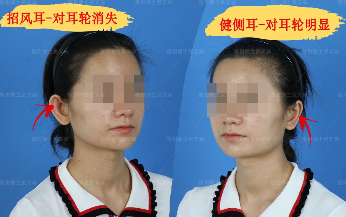 招风耳能整成正常耳朵吗,单侧招风耳有什么影响