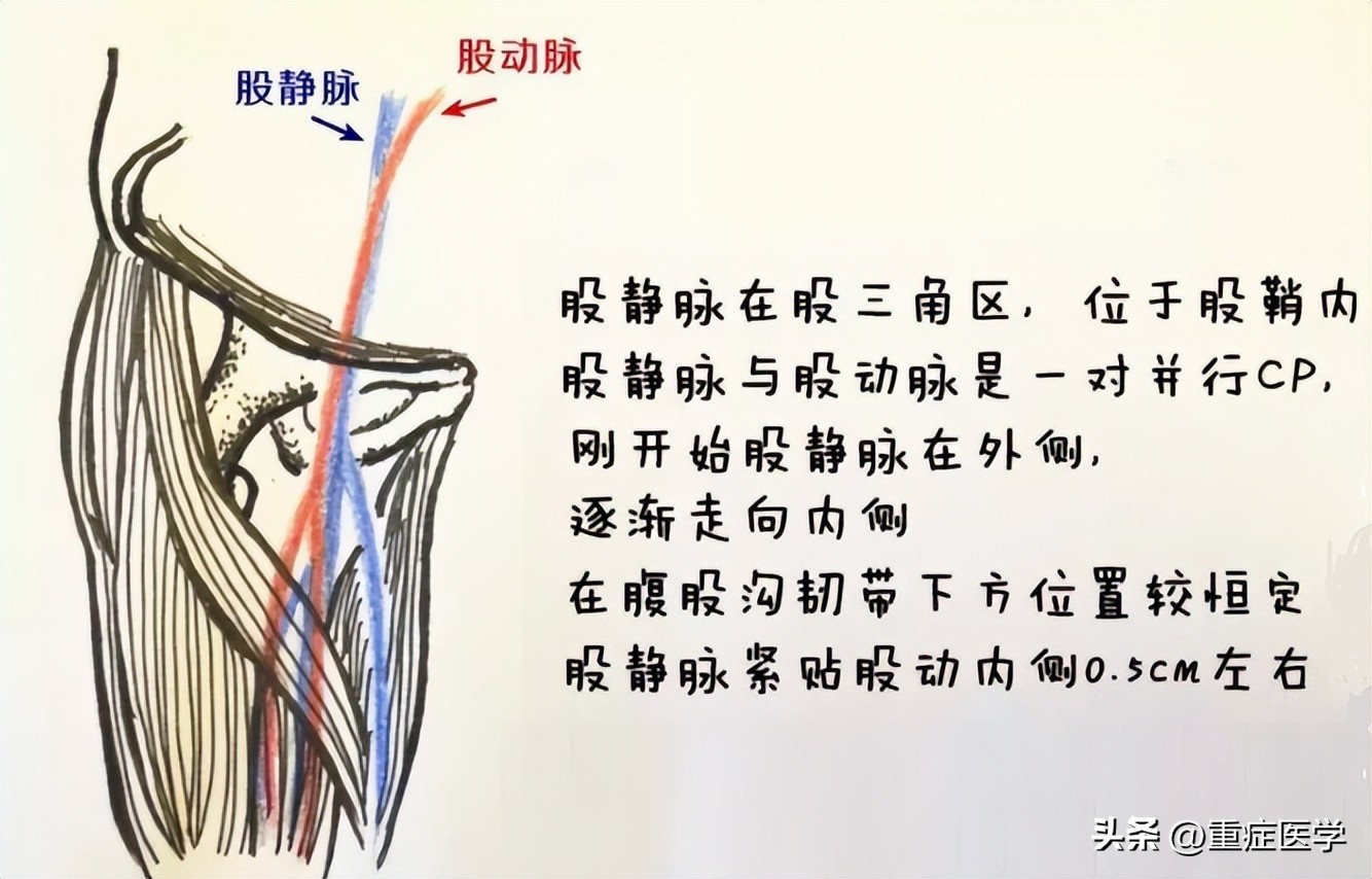 保姆级深静脉穿刺全攻略，建议收藏！