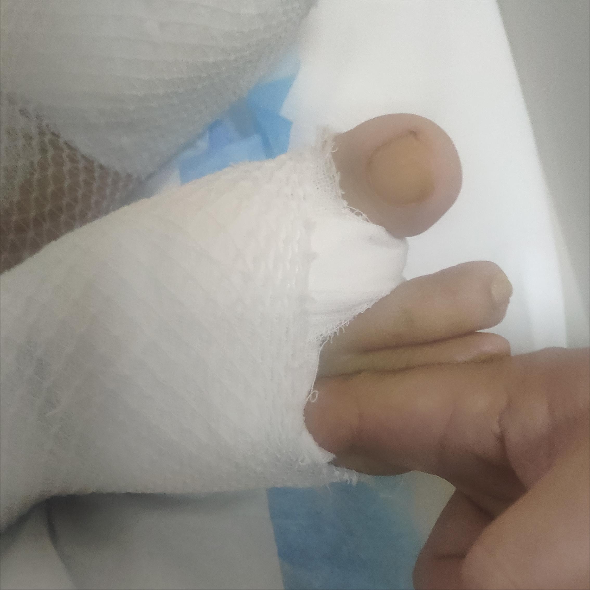 拇外翻手术后脚还在肿是什么原因,脚骨折手术后三个月还肿正常吗