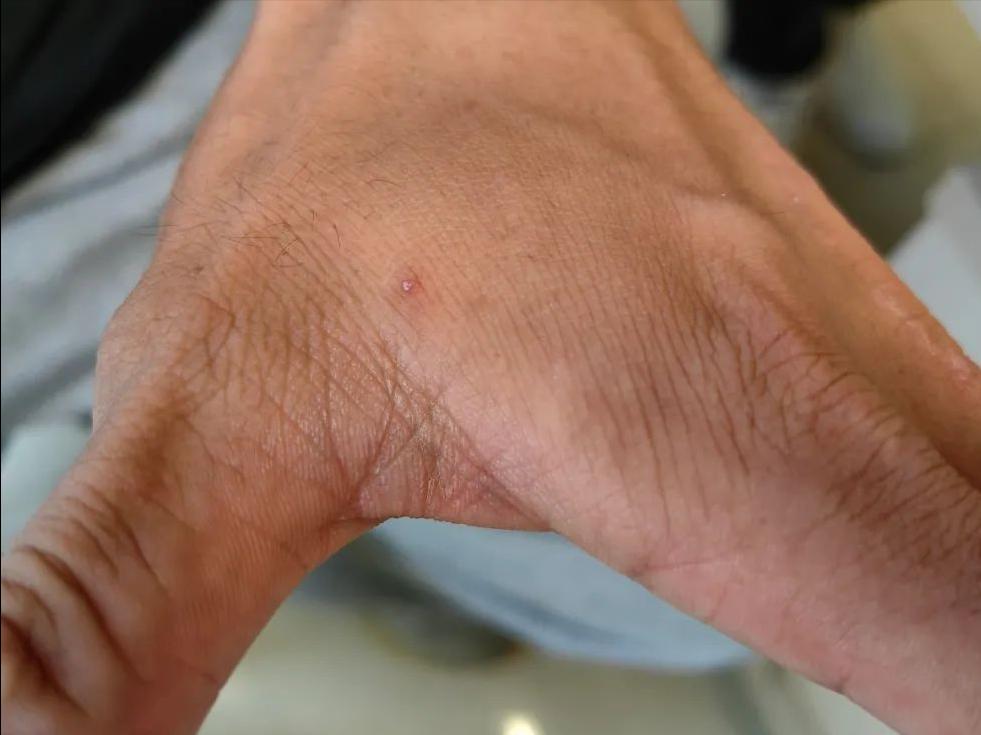 脖子前边痒是生病的前兆,腋窝和脖子痒是什么病的前兆