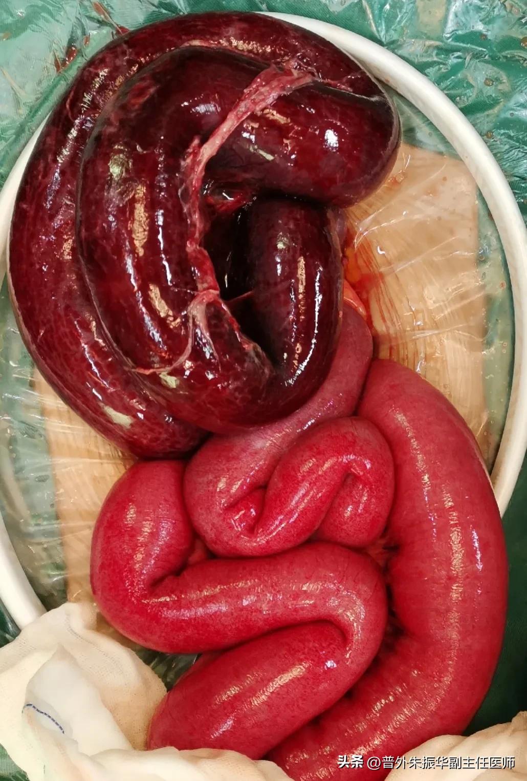 发生肠梗阻最好的治疗方法是,小孩肠梗阻怎么办