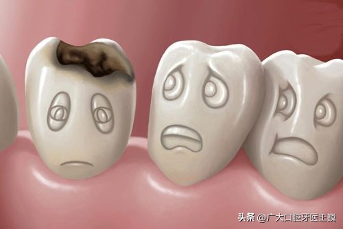 儿童蛀牙牙痛补牙还是根管治疗好,蛀牙烂空了是种植好还是治疗好