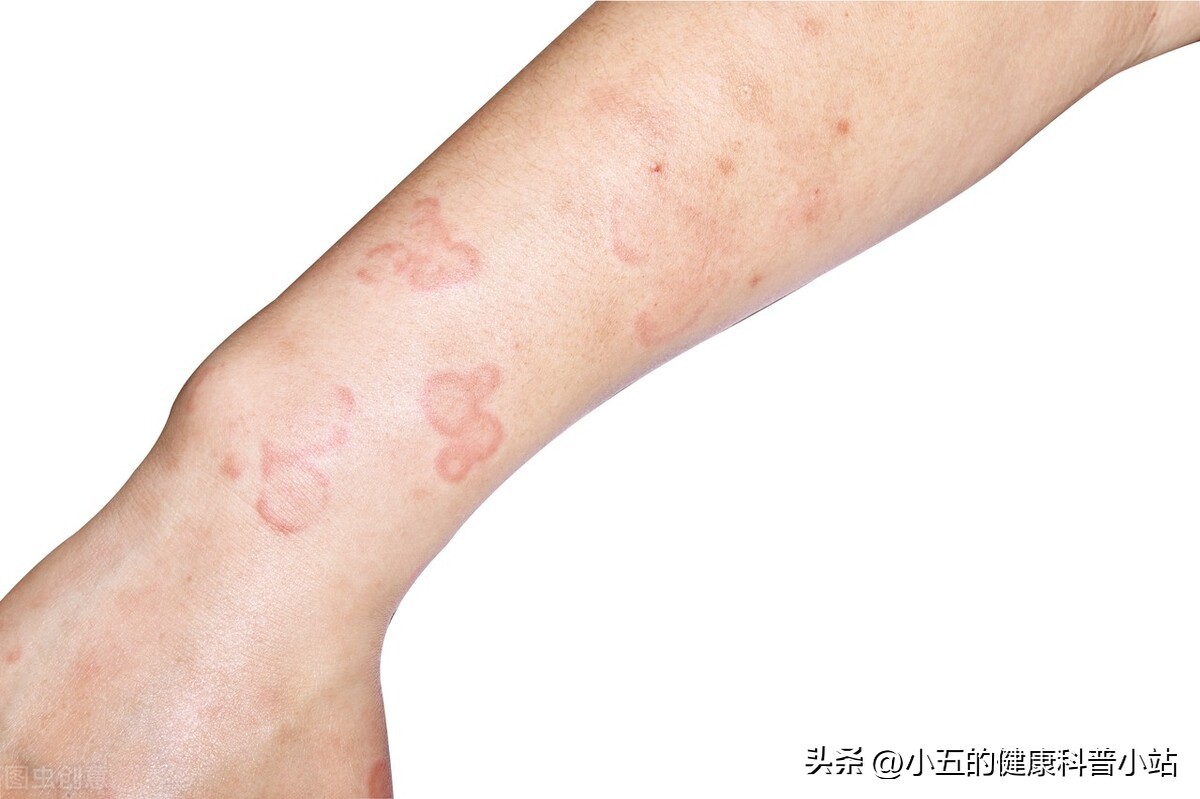 慢性荨麻疹依巴斯汀怎么吃,依巴斯汀片可以治疗过敏性鼻炎吗