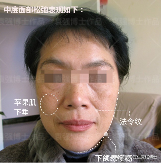 脸下垂有法令纹怎么办,经常耷拉的脸容易长法令纹