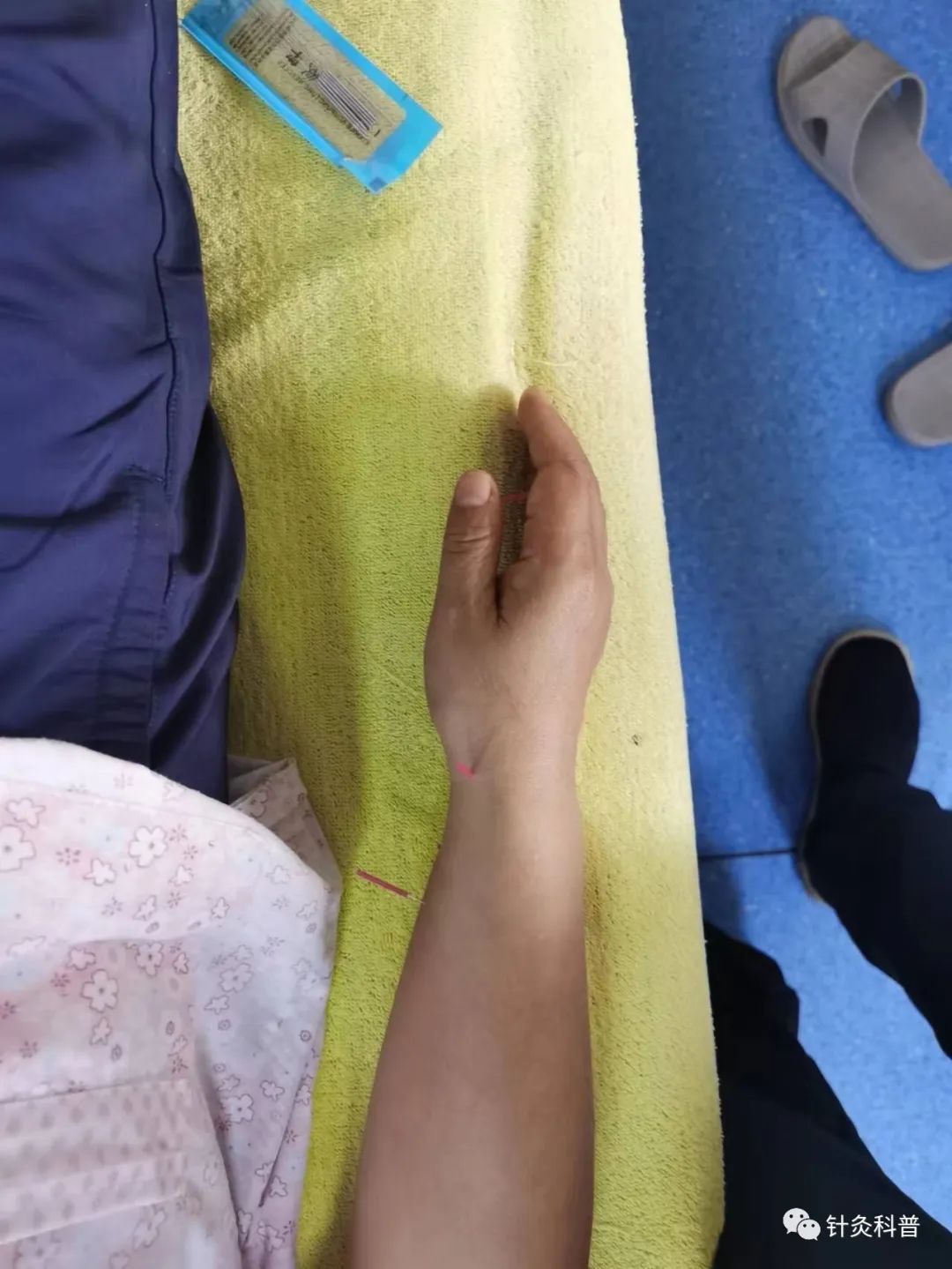 皮肤湿疹可以针灸治疗吗,针灸治疗脸上湿疹的绝招