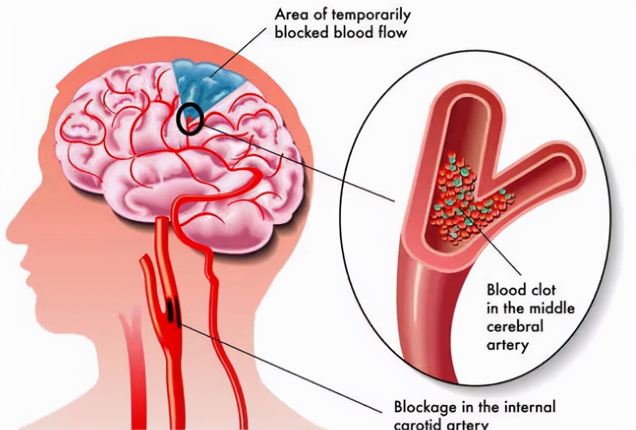 老人呛咳最佳治疗方法,老人睡觉老是呛咳是怎么回事
