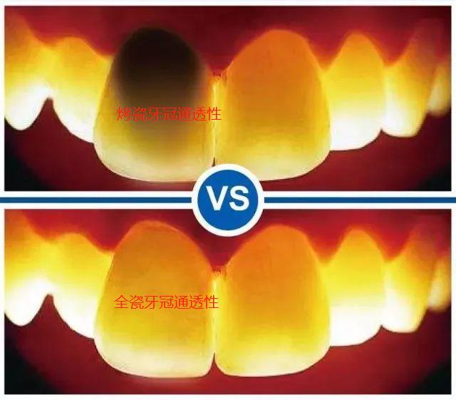 全瓷牙和烤瓷牙相比哪个更结实,全瓷牙和烤瓷牙哪个质量好一点