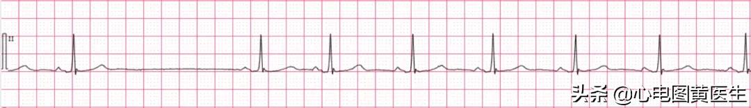 心电图读图注意事项,心电图读图练习软件