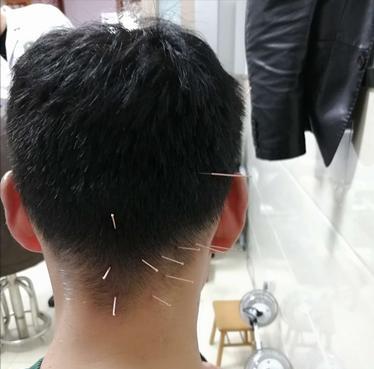 头部脑供血不足穴位,头部穴位针灸的作用