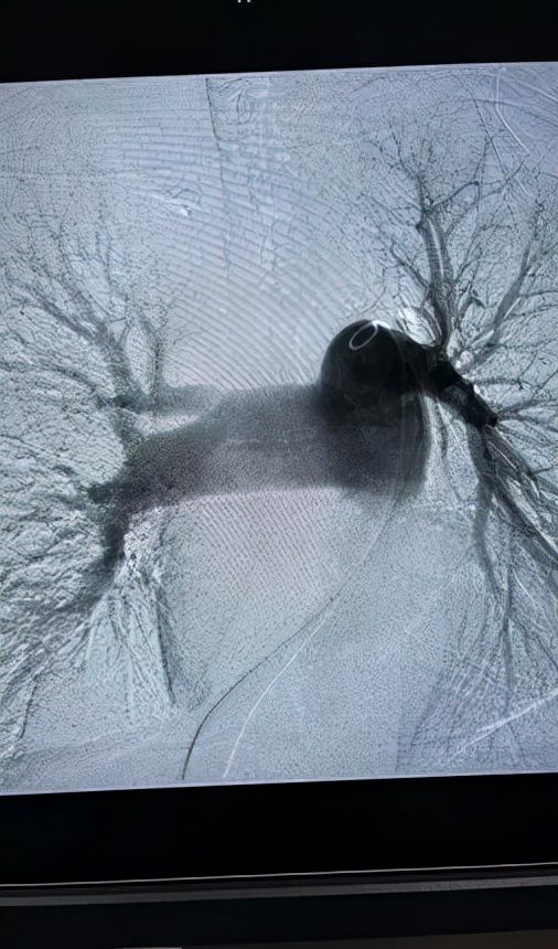 支气管动脉栓塞最严重术后并发症,支气管扩张并咯血的介入栓塞治疗