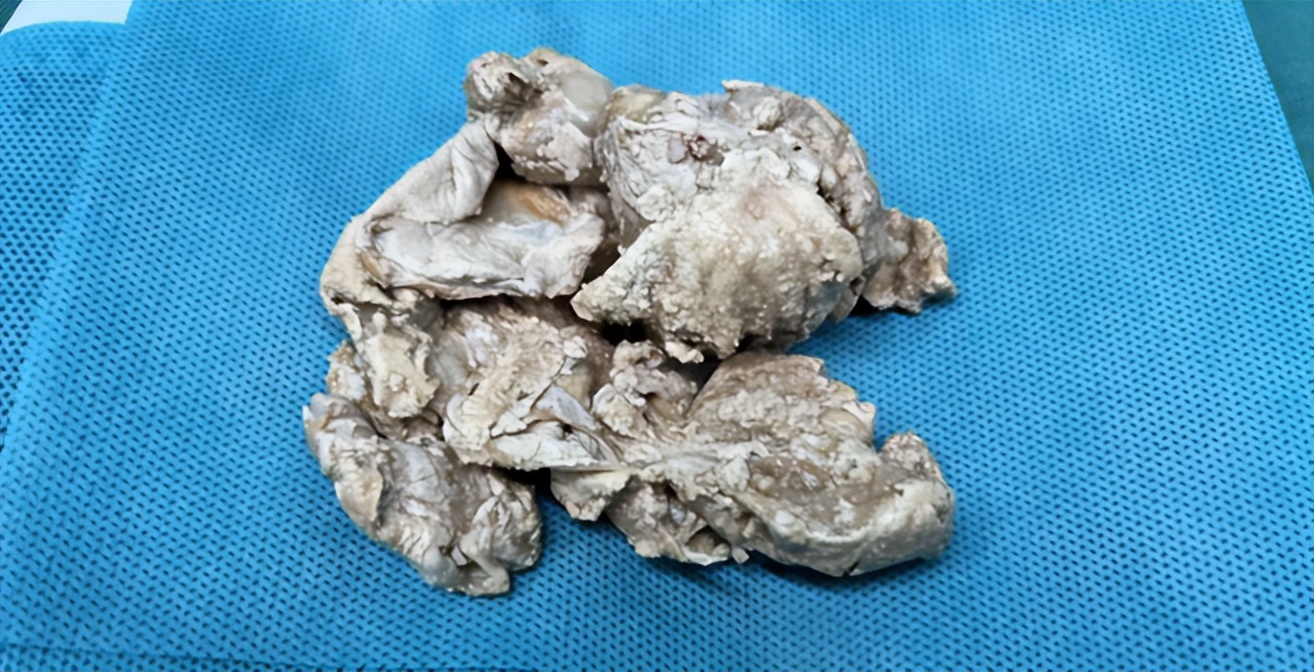 直肠内异物看病经验分享,直肠内壁异物