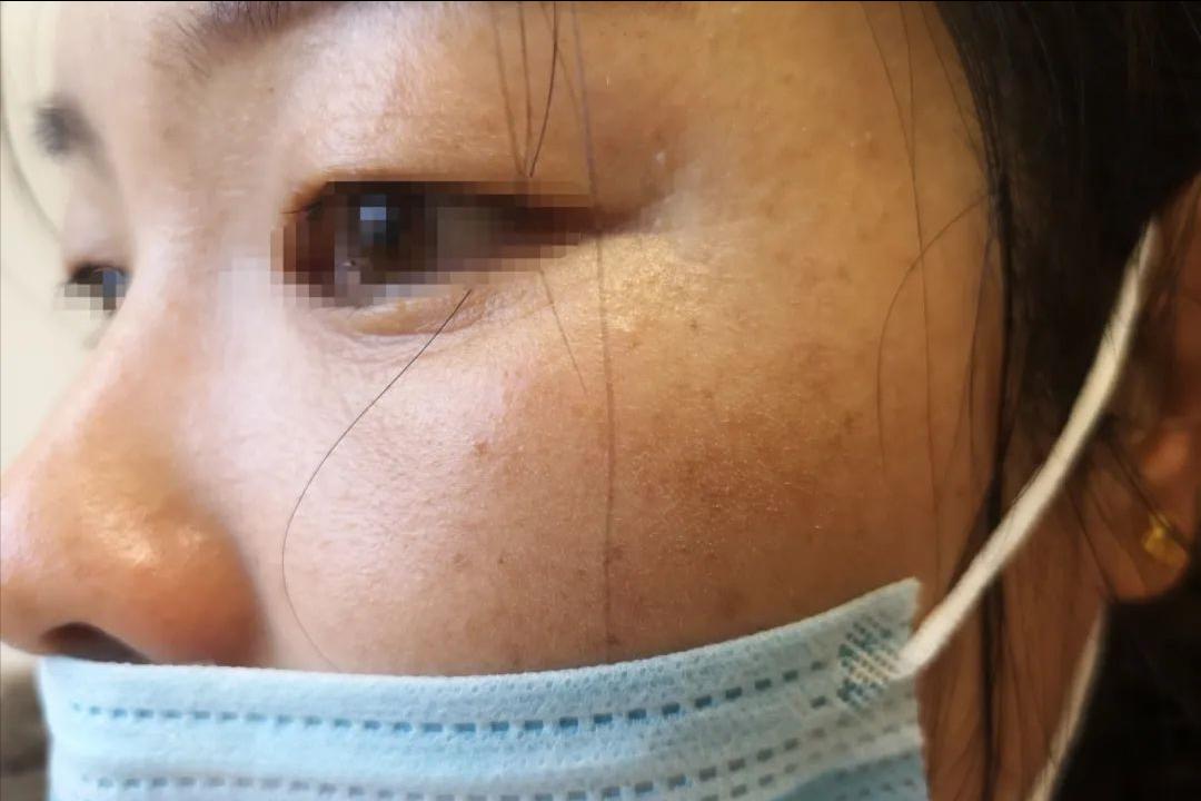 炎症后皮肤粗糙增厚发黑,炎症后脸上留下黑斑