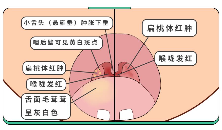孩子咳嗽嗓子疼怎么治最快最有效,咳嗽误诊