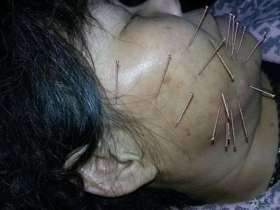 知青故事赤脚医生,知青中的赤脚医生