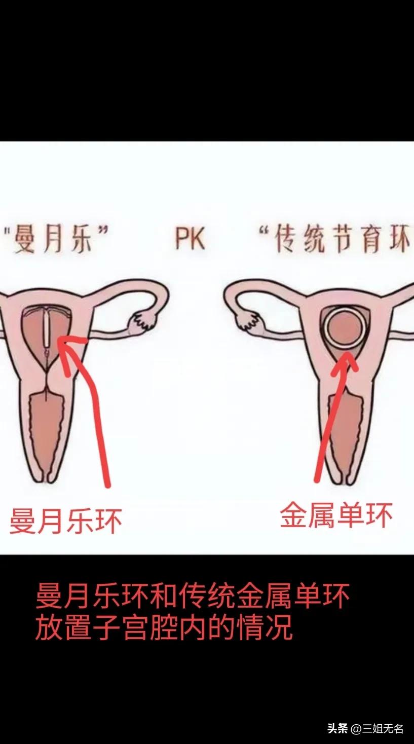 长效避孕哪种方法最好,用什么避孕方法最好呢