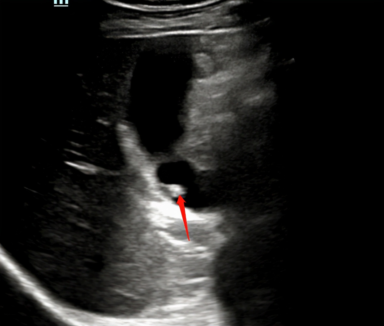超声所见正常范围准确吗,超声看不清楚